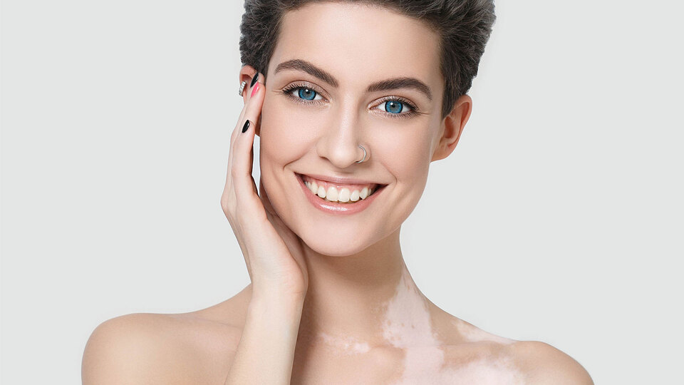 Halk arasında beyazlama hastalığı olarak biliniyor! İşte vitiligoya dair merak edilenler...