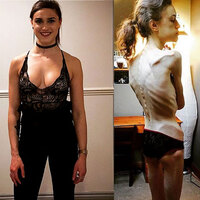 "Erkek arkadaş bulamıyorum" diye anoreksik olmuştu! Son hali şaşırttı