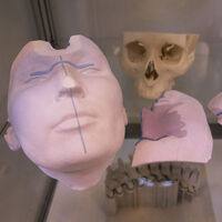 Kanser cerrahisinde "3D" teknolojisi