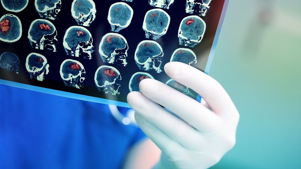 Temporal lob epilepsisi, beynin duyguları kontrol eden bölümünü etkiliyor!