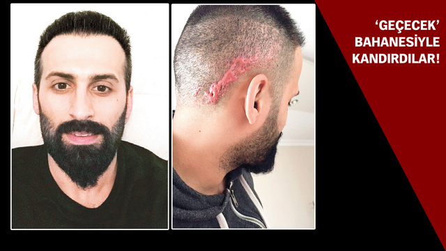 Ektirdi, saç yerine keloid çıktı!