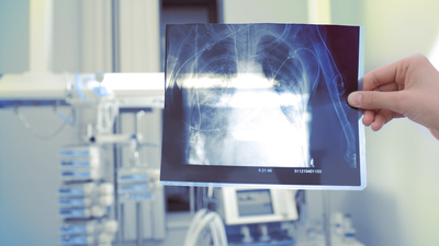 Hayatları karartan hastalık: Silikozis