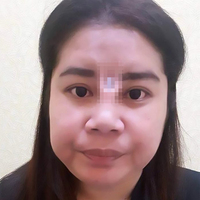 Taylandlı bir kadın ucuz estetik kurbanı oldu!