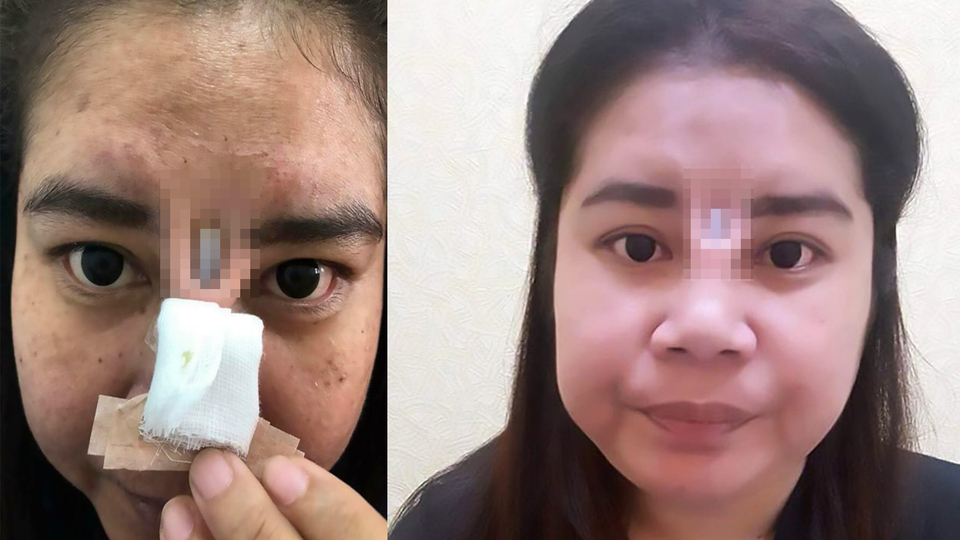 Taylandlı bir kadın ucuz estetik kurbanı oldu!