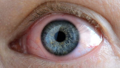 Göz iltihabı belirtileri nelerdir?