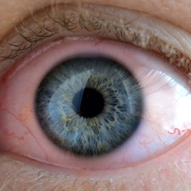 Göz iltihabı belirtileri nelerdir?