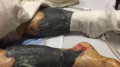 Dikkat sizin de başınıza gelebilir... Pişirmeden yedi, sonrası dehşet!