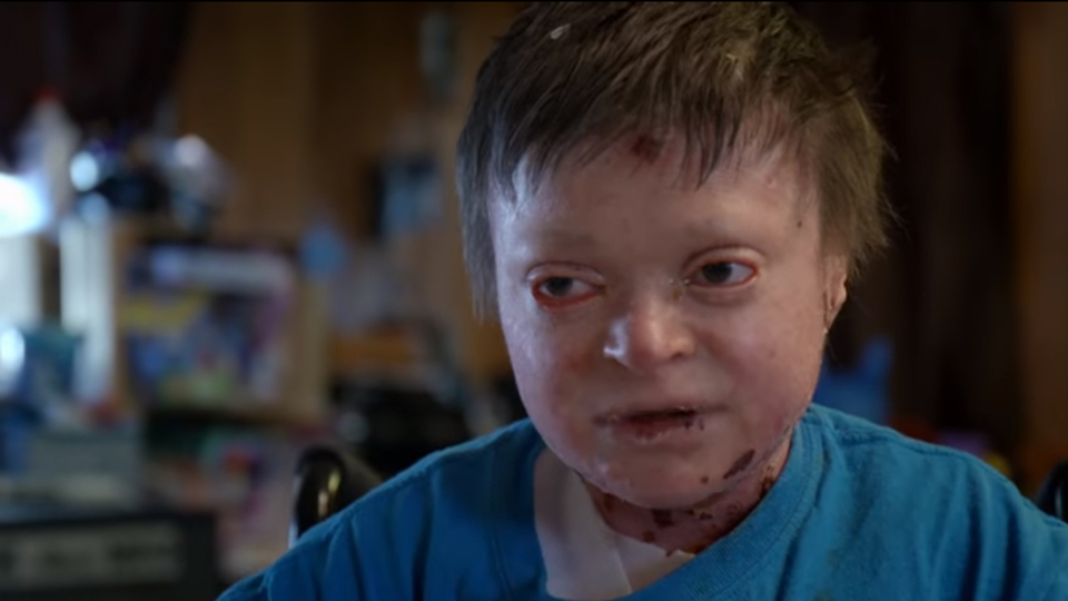 Derisiz doğan çocuk tedaviyi reddediyor! İşte nedeni...