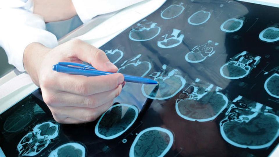 Türkiye'de 10 kişiden 1'i 'epilepsi bulaşıcı' dedi