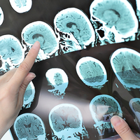 MS hastalığı ile baş etmenin yolları!