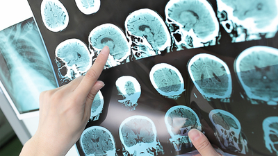 MS hastalığı ile baş etmenin yolları!