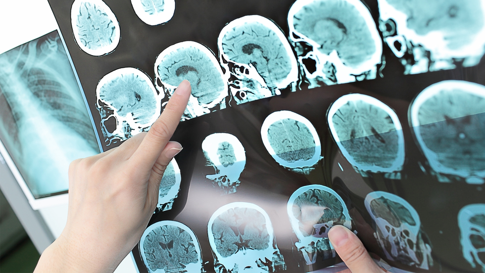 MS hastalığı ile baş etmenin yolları!