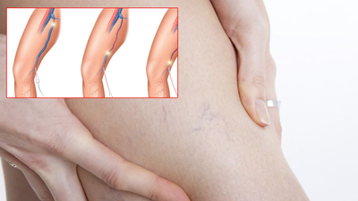 100 kadından 70'i varis sorunu yaşıyor