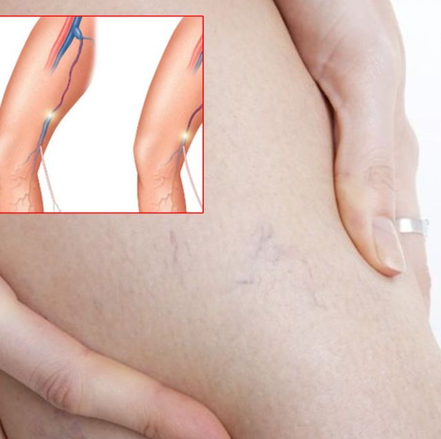 100 kadından 70’i varis sorunu yaşıyor