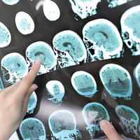 Dikkat! Tedavi edilmeyen grip felç ediyor