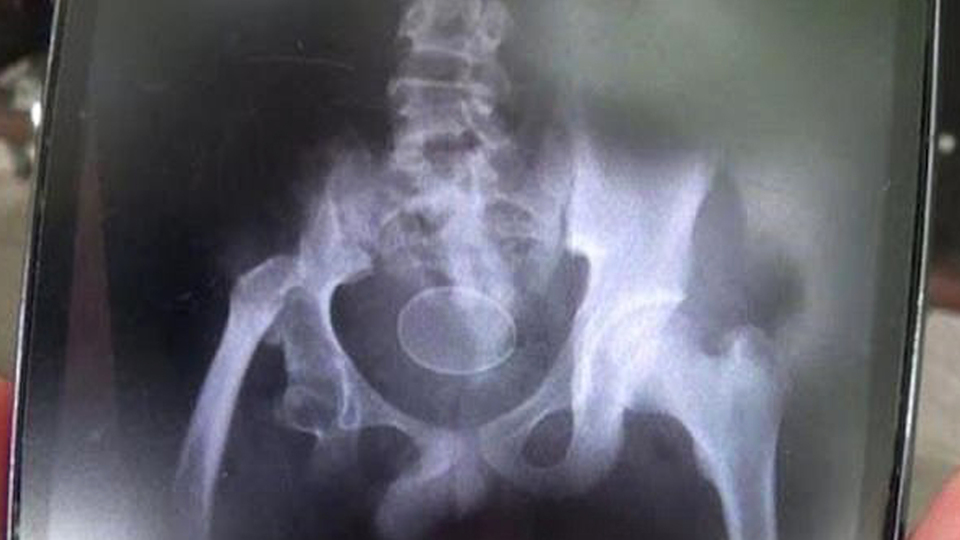 Doktorları şaşkına çevirdi! Tavuk gibi yumurtladı...