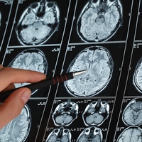 Hastanın kalbinden beynine pıhtı attı! Doktor uyardı: İlk 6 saatte müdahale şart!