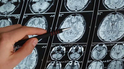 Hastanın kalbinden beynine pıhtı attı! Doktor uyardı: İlk 6 saatte müdahale şart!