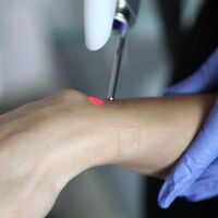 Yargıtay epilasyon yapan uzmana beraati bozdu