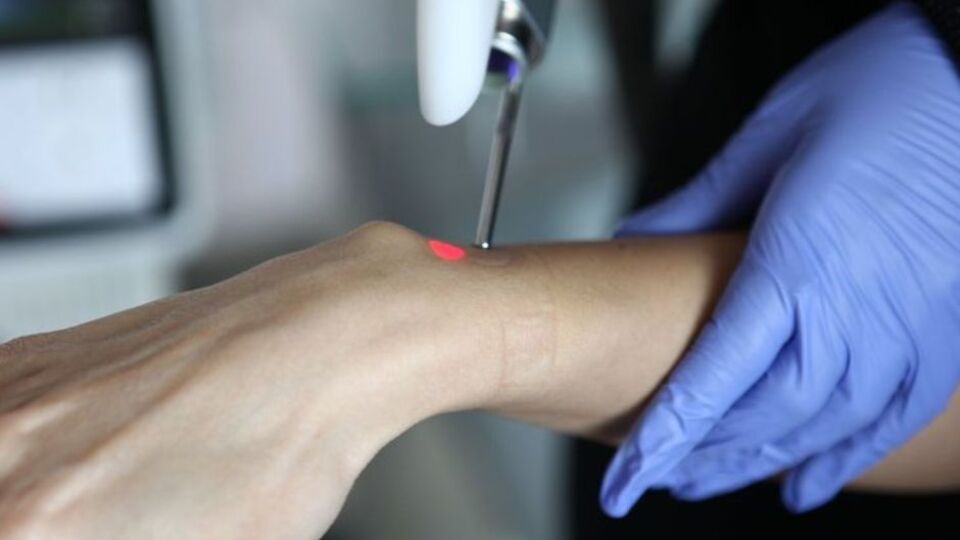 Yargıtay epilasyon yapan uzmana beraati bozdu