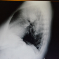 Akciğerinden ayva büyüklüğünde kitle çıktı