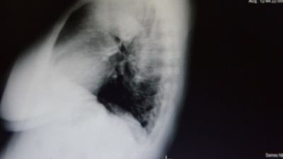 Akciğerinden ayva büyüklüğünde kitle çıktı