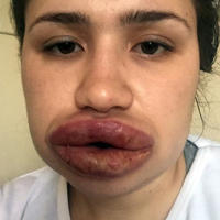 Silikon mağduru Merve hemşirenin son hali!