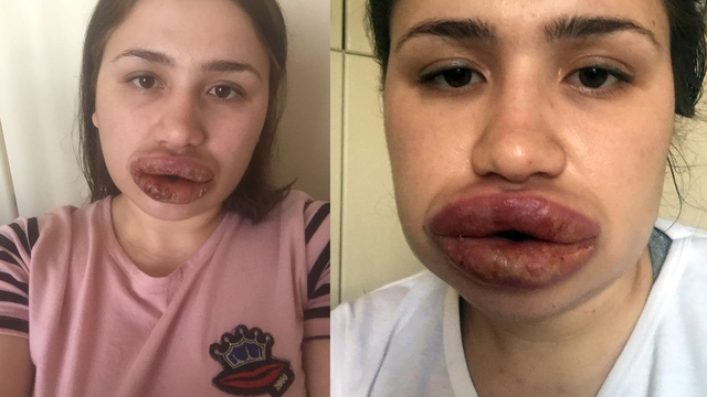 Silikon mağduru Merve hemşirenin son hali!