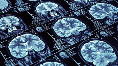 Epilepsi hakkında doğru bilinen yanlışlar!