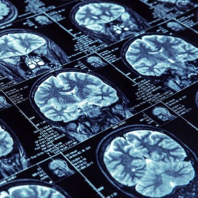 Epilepsi hakkında doğru bilinen yanlışlar!