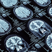 Alzheimer plakalarını farelerde yok edebilen antikor üretildi