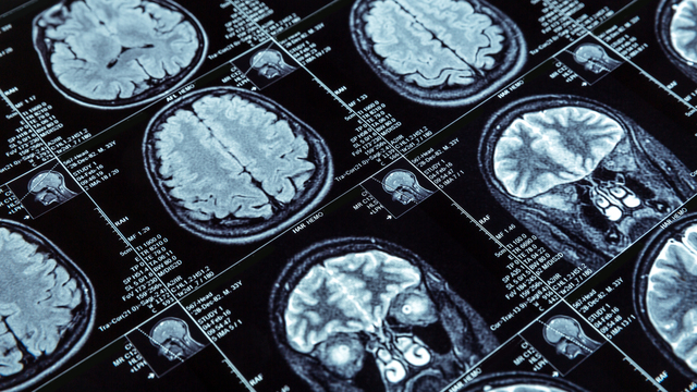 Alzheimer plakalarını farelerde yok edebilen antikor üretildi
