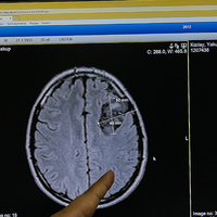 Dudak uçuklatan operasyon! Tümörü çıkarmak için kafatasını çıkardılar...