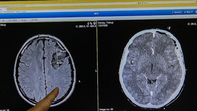 Dudak uçuklatan operasyon! Tümörü çıkarmak için kafatasını çıkardılar...