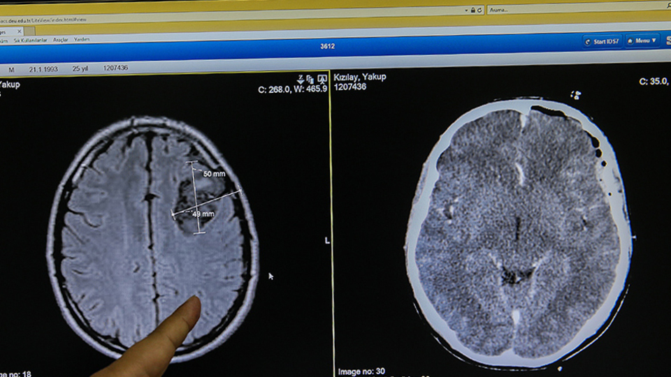 Dudak uçuklatan operasyon! Tümörü çıkarmak için kafatasını çıkardılar...