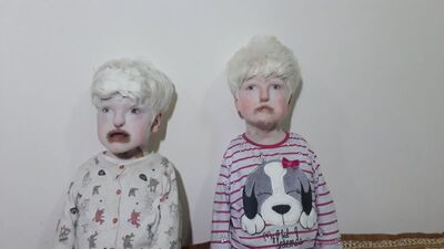 Mardinli kız kardeşler hem albino hem de duyma ve konuşma engelli...