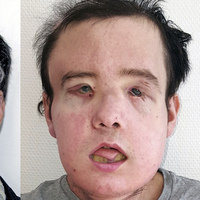 İlk yüzü ölünce ikinci yüz nakli yapıldı