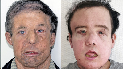 İlk yüzü ölünce ikinci yüz nakli yapıldı