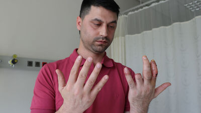 Dört parmağından üçüne yeniden kavuştu