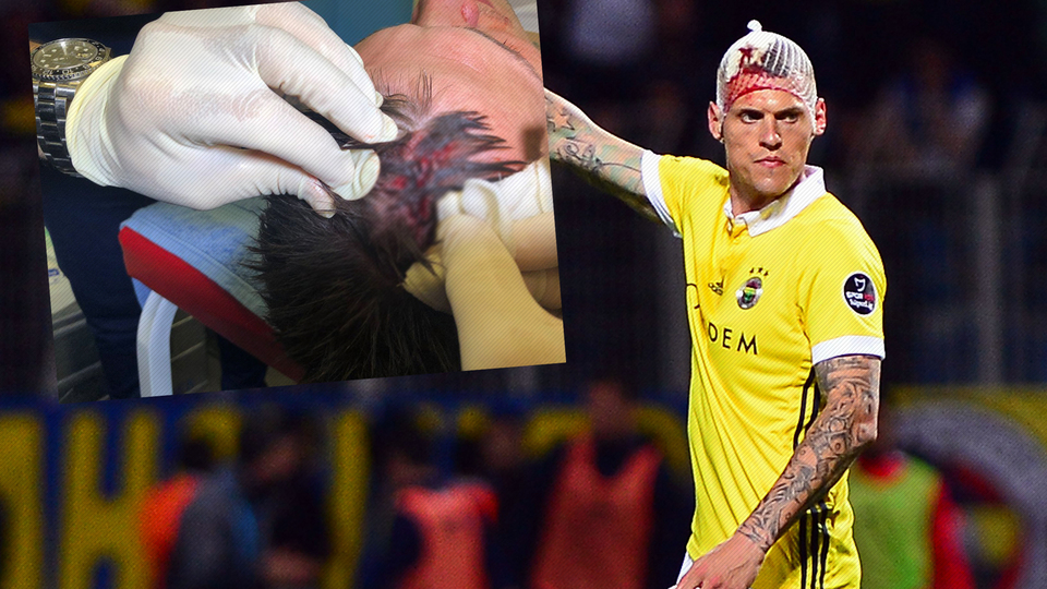 Skrtel'den kötü haber! 10 dikiş...