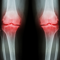 Kemik erimesinden bu gıdalarla korunun!