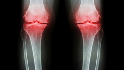 Kemik erimesinden bu gıdalarla korunun!