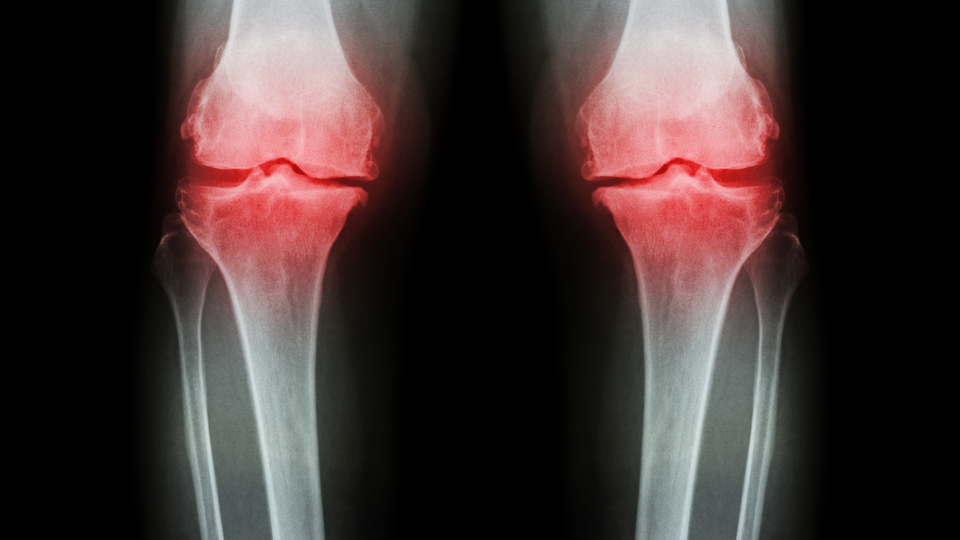 Kemik erimesinden bu gıdalarla korunun!