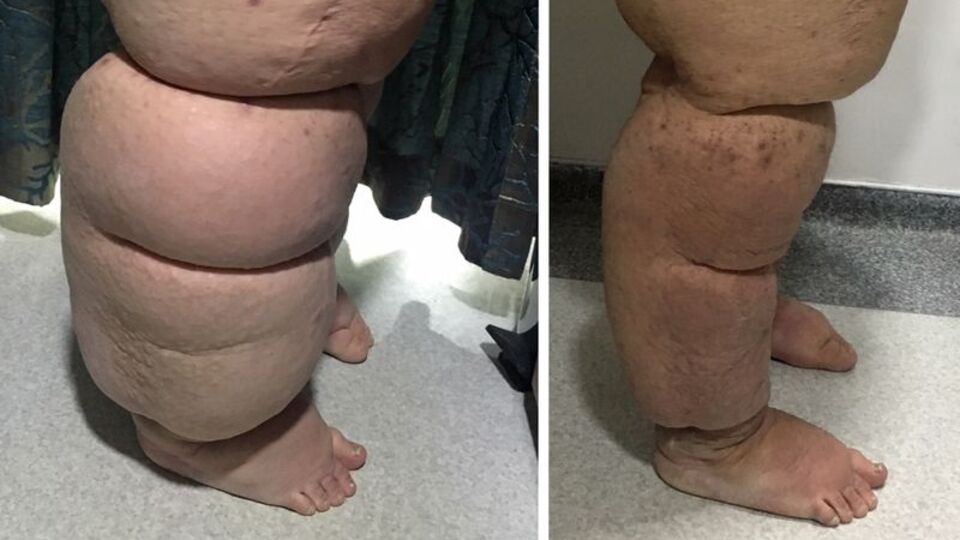 Önemsemediğiniz bir şişlik ömür boyu sürecek sıkıntıya sebep olabilir!