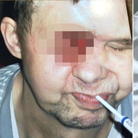 Yüzünün tam ortasında dev bir delik meydana geldi! Dikkat sizin de başınıza gelebilir!