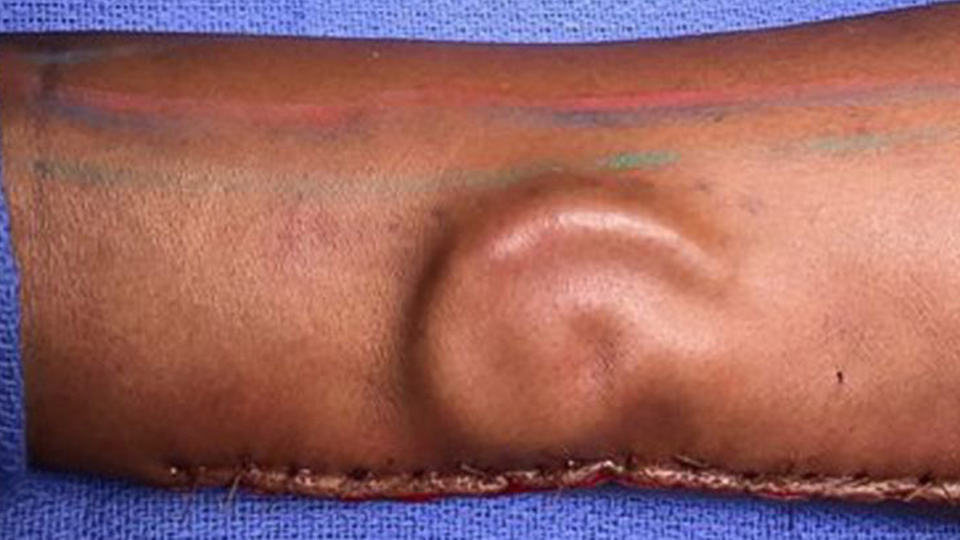 Mucize! Kaburgadan kulak yapıp, kolunda büyüttüler!