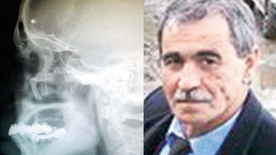 Kafasında 40 yıl mermi ile yaşadı