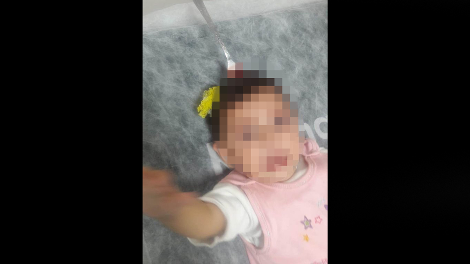 Bebeğin kafasındakini gören doktorlar şoke oldu