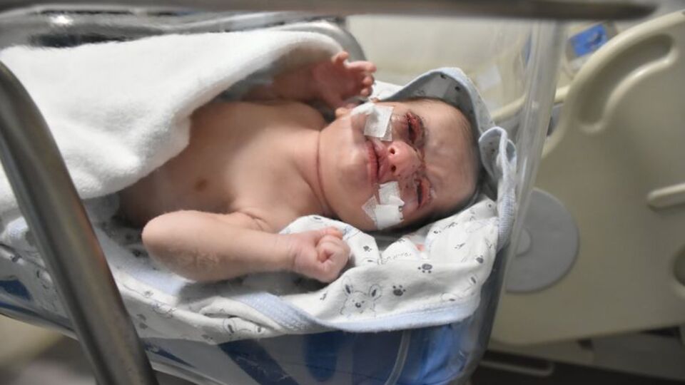 Dört günlük bebeğe kulak derisinden göz kapağı!