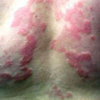 Egzama hastaları dikkat! Eğer hastalık ilerlerse...